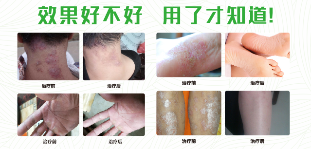 香蕉视频免费下载真菌清喷剂